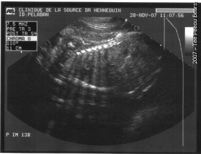 Echographie de Qudina